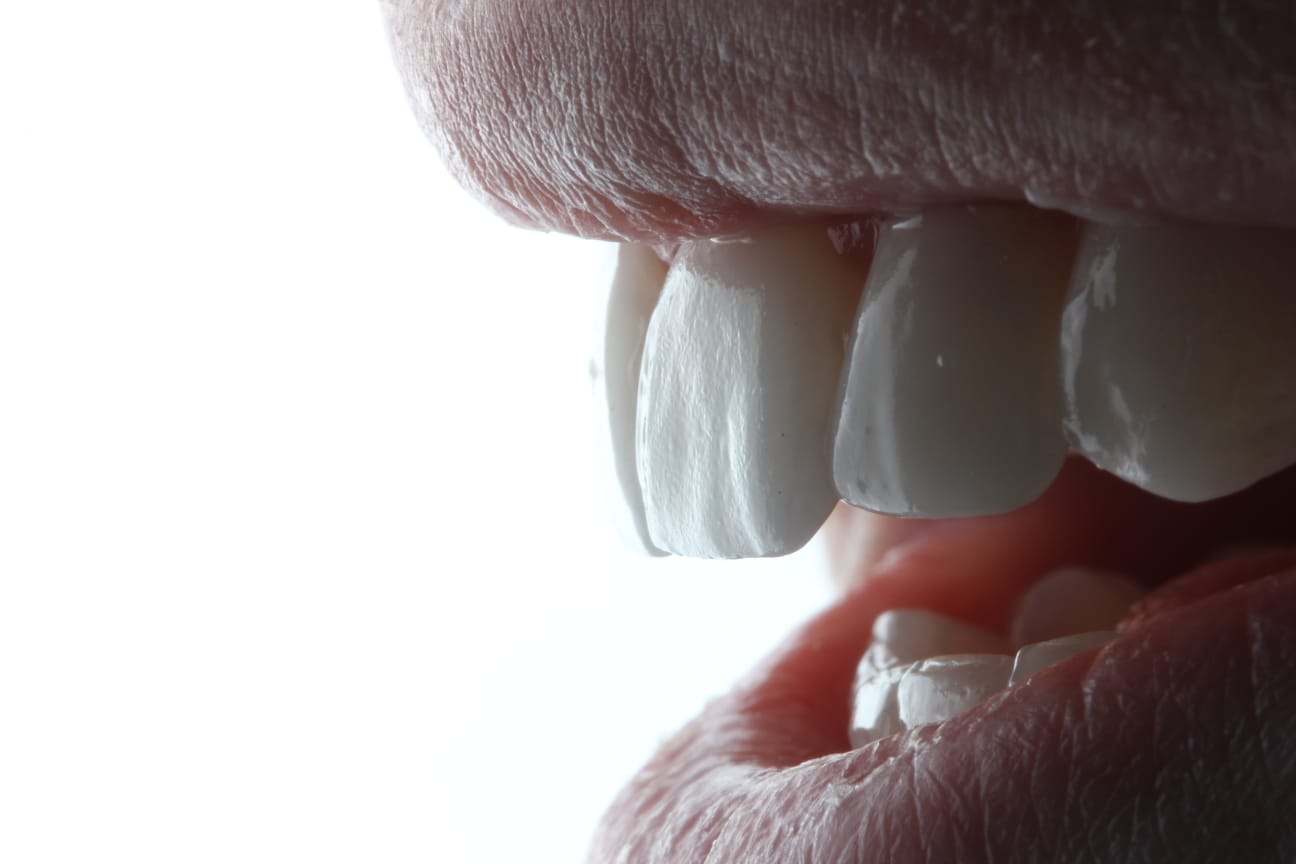 Top 5 Reasons Why You Should Consider Getting Dental Veneers in Colombia